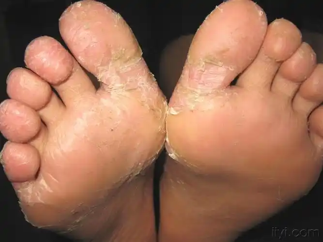 看图识病:幼年跖部皮病 - 皮肤及性传播疾病讨论版 - 爱爱医医学论坛