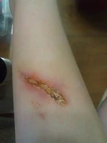 在工地上走的时候被锈铁划伤了腿