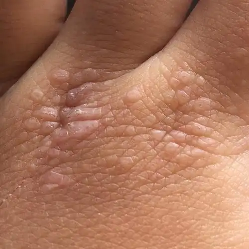 夏天到来,小朋友的皮肤出现小丘疹,这是什么病?