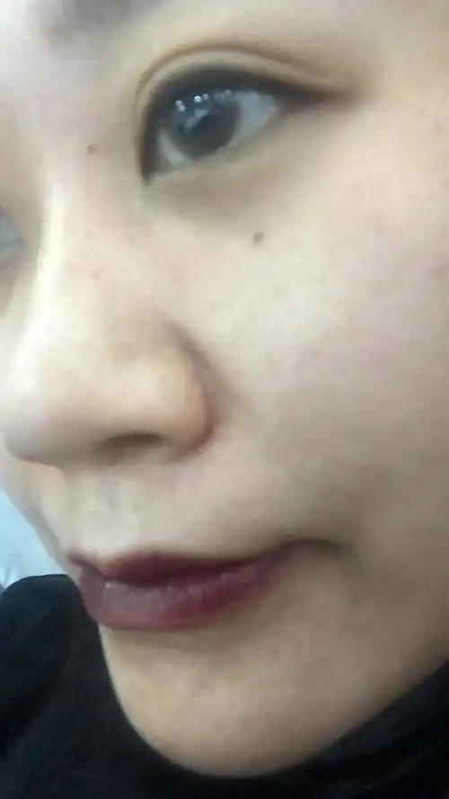 左边鼻翼有点肿硬是增生了吗