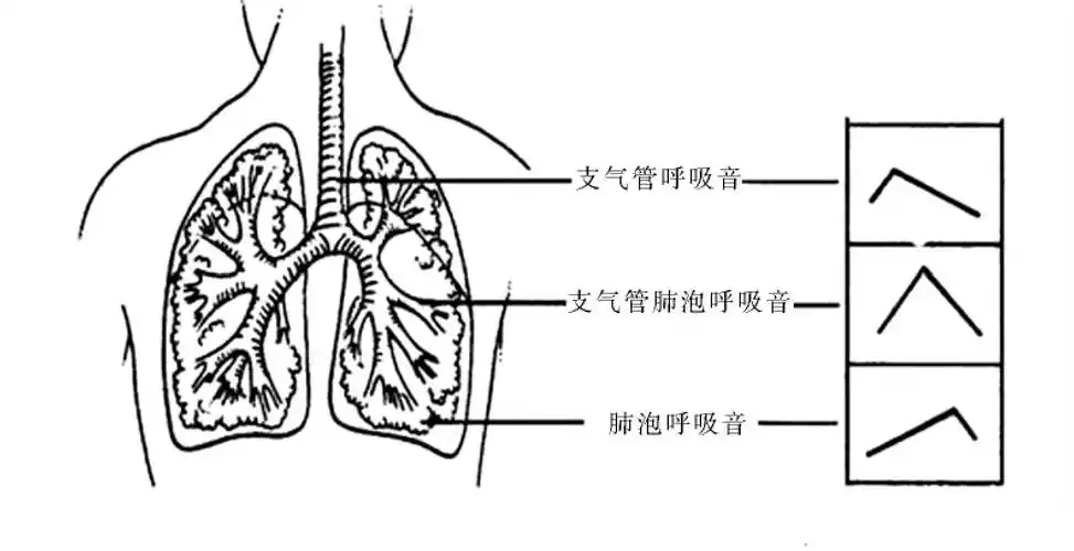 图4-5-5 正常呼吸音评估示意图在正常肺泡呼吸音的部位听到了支气管