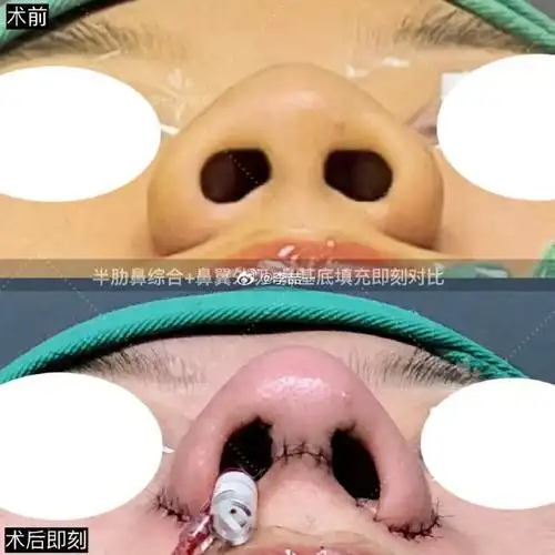 这个妹妹就属于这种鼻型,她的主要诉求也是