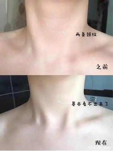 女人脖子出现"三条杠",你知道代表什么吗?早知道早好