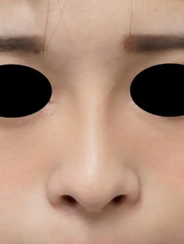鼻プロテーゼ(i型) 手术前 正面 before