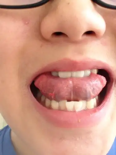 像是上火.怎么办