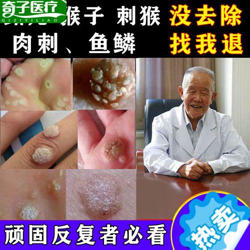 京健康子的药肉粒疙瘩鱼鳞痣休子点瘊子痦子治肉刺去除神器手 除 除