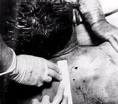 肯尼迪尸检照片