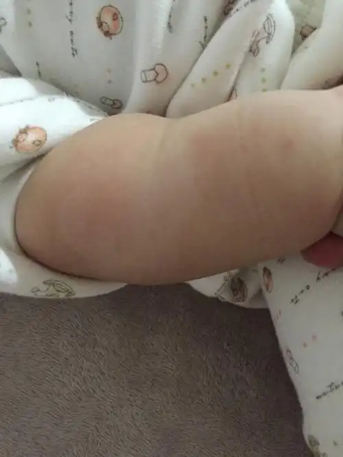 今天发现宝宝肚子上有一块白斑是怎么回事啊!