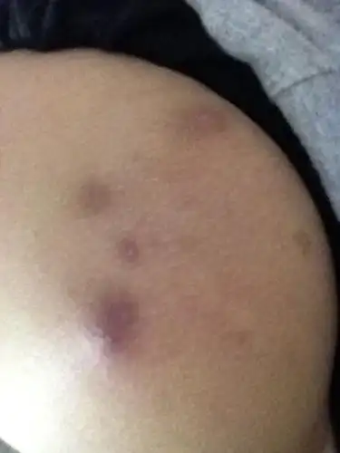 个疮按它就疼,坐在凳子上我只敢用书垫着,不动它就不疼,这是什么症状