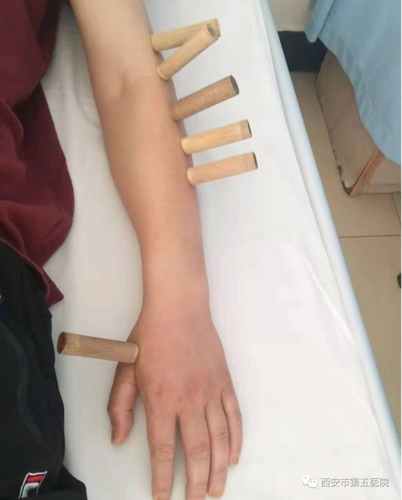 中医药物罐疗法