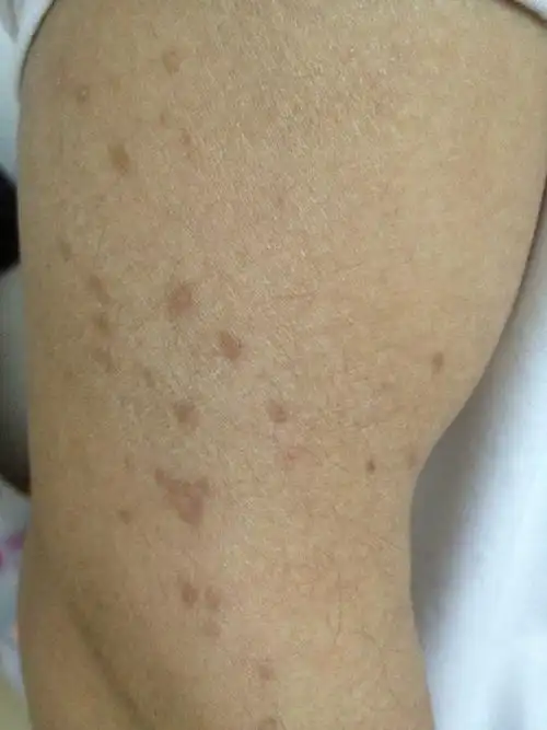 手臂上怎么会突然长很多斑点,会不会传染呢?