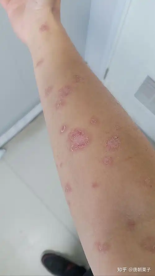 我的三个月玫瑰糠疹之路