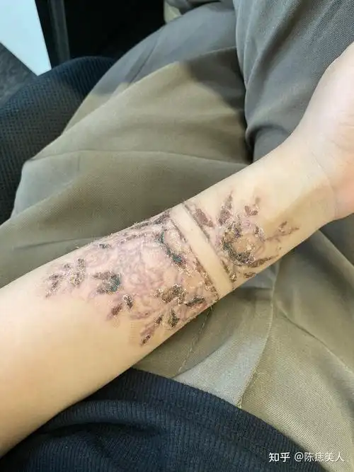 202183记录洗纹身的恢复过程