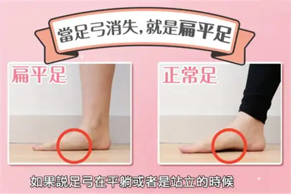 什么是扁平足 确诊为扁平足要怎么恢复