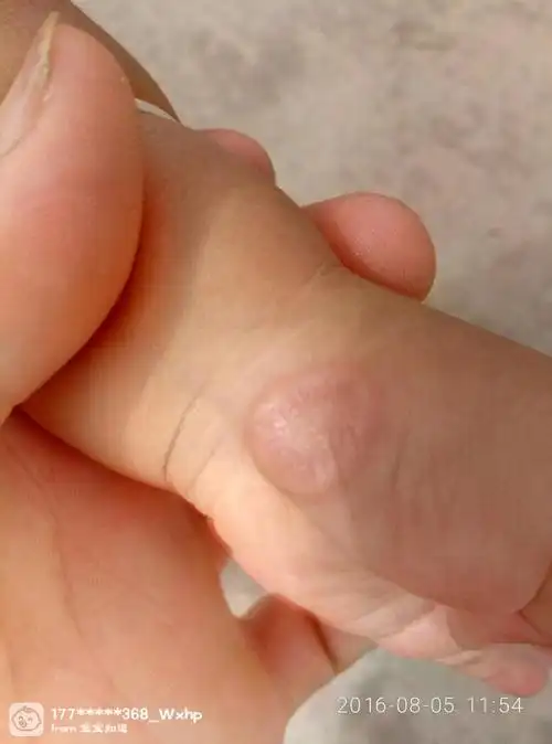 宝宝手上长了个痘痘