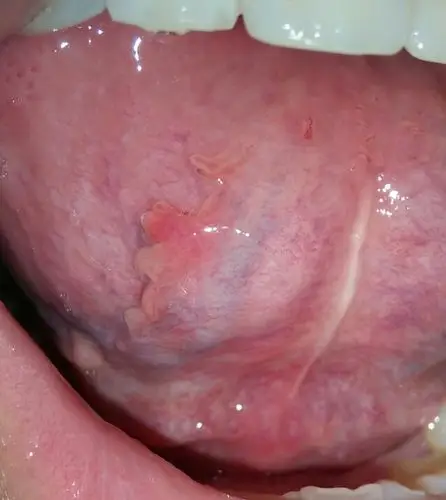 舌头下面肿了,不知道是什么原因,希望有专业人士帮看看,前段时间口腔