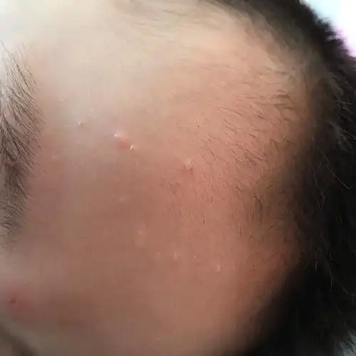 宝宝从几个月开始额头就长了图中的小白点,现在一岁半,小白点越长越