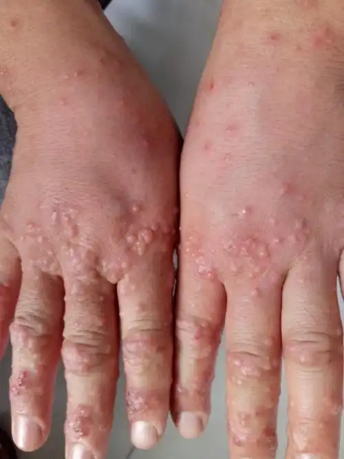 15年庆《全科医师皮肤病看图诊断》——丘疹,疱疹,微痒(5) - 全科医疗