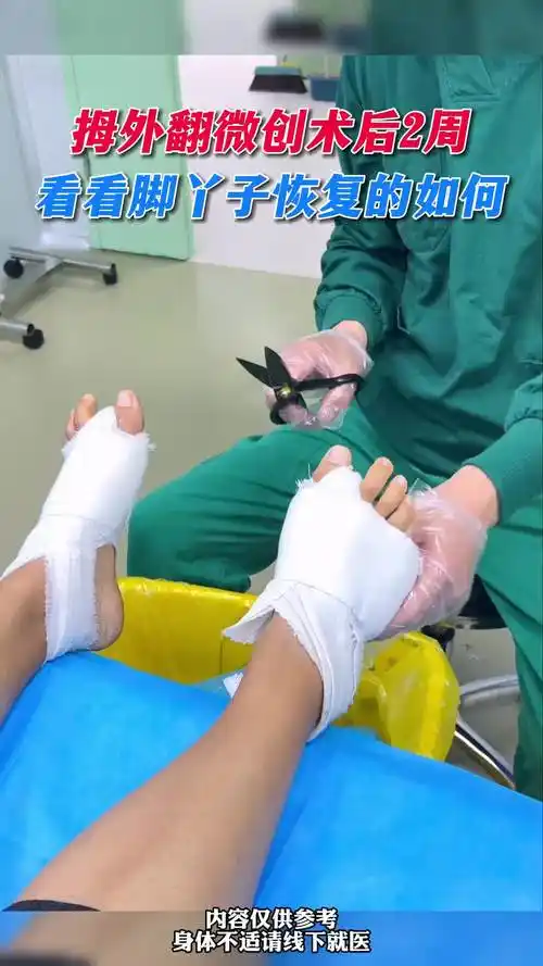 拇外翻微创术后2周,看看脚丫子恢复的如何