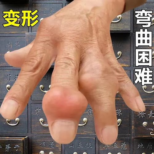 无品牌手指骨节肿胀变形手指关节疙瘩鼓包手指肿胀手部防护痛风湿关节