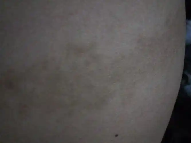 腰上长褐色的斑刚开始没注意慢慢就痒还掉皮像挫掉的灰一样