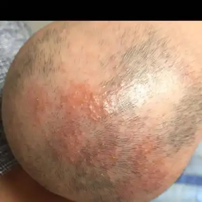 你好我孩子两个多月大了,现在头上起红点,还有出脓现象,请问是怎麼