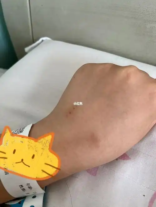 肛周脓肿 混合痔第五天