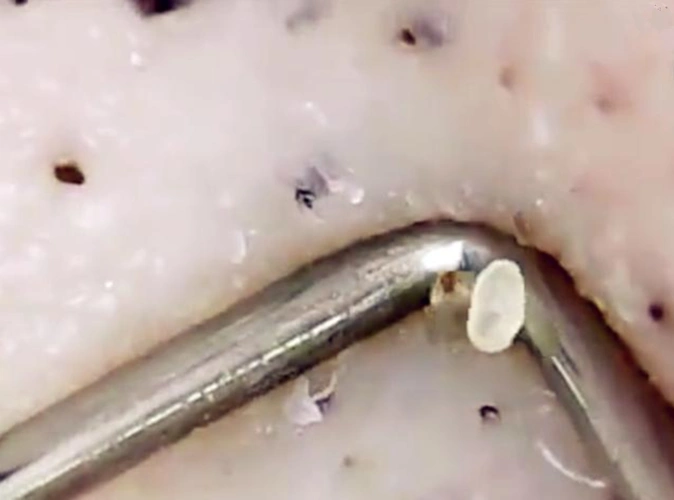 皮肤感染螨虫怎么办?教你一招轻松解决!