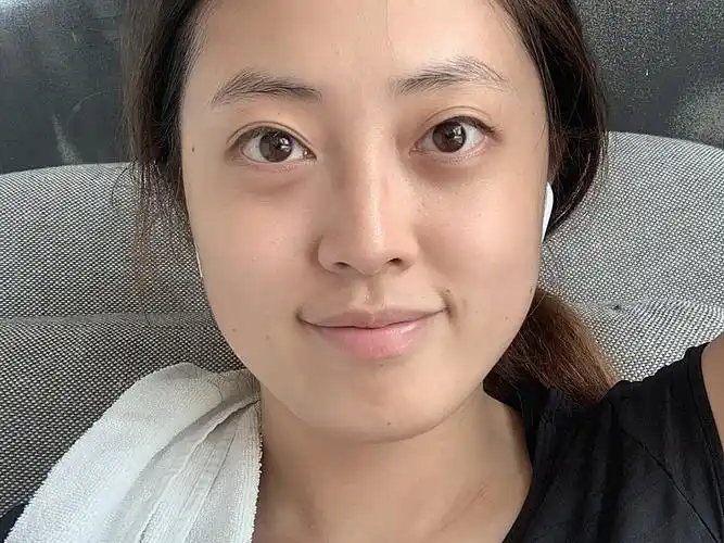 术前诊断求美者是公司职员,由于工作的性质需要经常