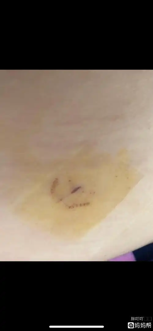 腹腔镜术后七天,伤口愈合情况