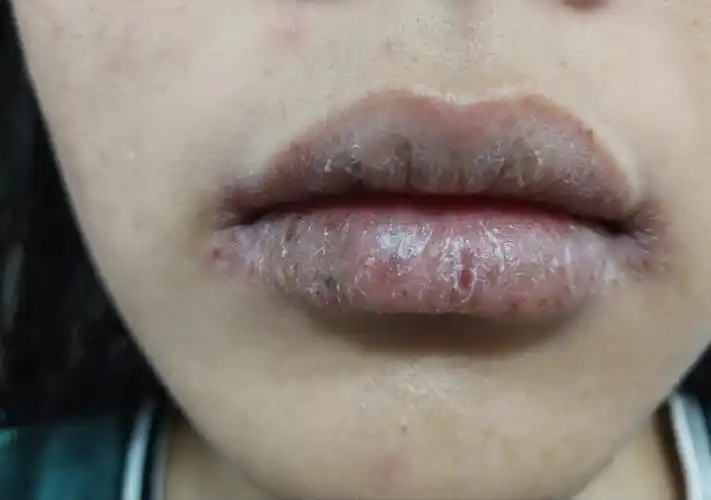 治疗嘴角起皮开裂口角炎