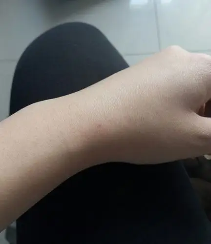 手上一个小红点,几年了,怎么理解.