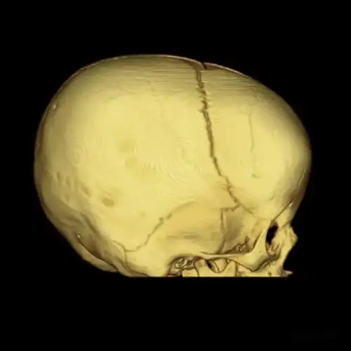 聚沙成塔 | 窄颅畸形/狭颅症_封合