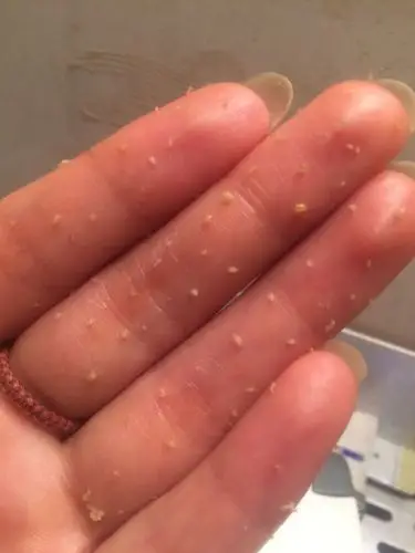 脸上长的这是什么东西,挤出来就是一个硬颗粒,各位护肤专家帮我看看