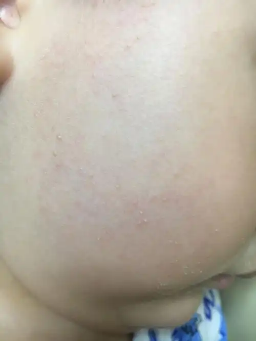 三岁多小孩这断时间脸上开始长一粒粒的白色的东西,请问这是什么?