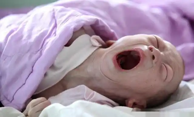 专家引见,经过对孕妇血液抽取化验,筛查胎儿21三体综合症的重要指标