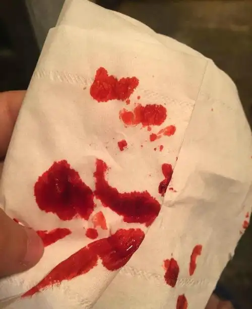 孕反咳血正常吗?我吐了快两个月,胃疼的不行,每天都吐血.