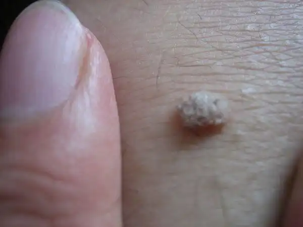 我起的是瘊子吗?该怎么治疗?