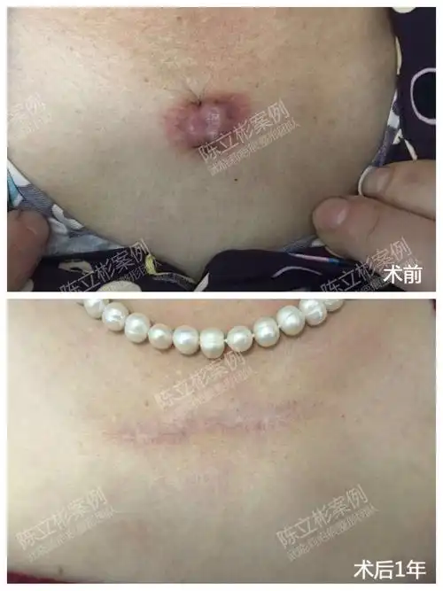 胸部疤痕疙瘩术后1年随访