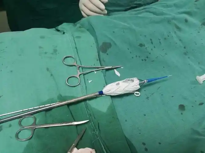 心胸血管外科首例主动脉弓开窗支架腔内隔绝术