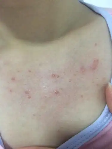 一开始以为痘痘用了面部祛痘精华,没好,后来用来以为是毛囊炎,用了