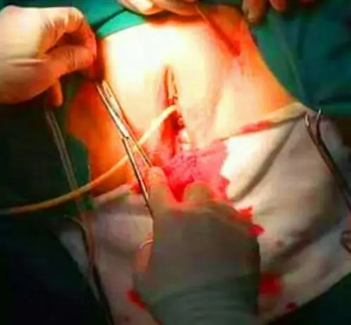 的带领下,我们在两小时内顺利完成了三例经闭孔阴道无张力尿道悬吊术