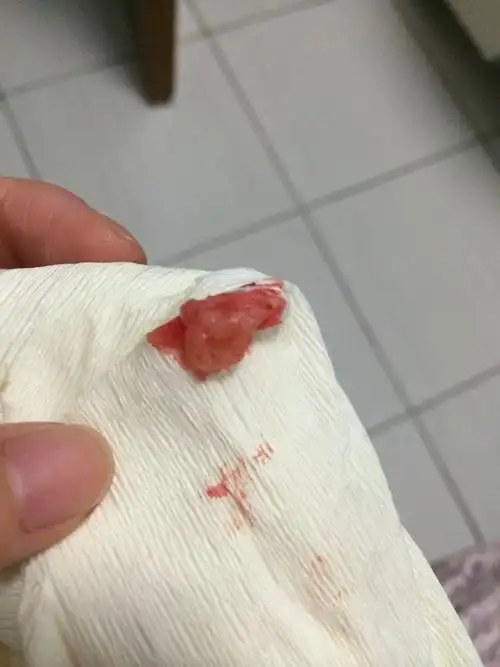 怀孕40多天流产,出来个这个东西,能帮我看下是不是孕囊嘛?