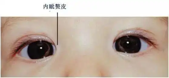 对眼(斗鸡眼)对眼又称为内斜视,几乎三岁内的孩子都有对眼现象,是因为