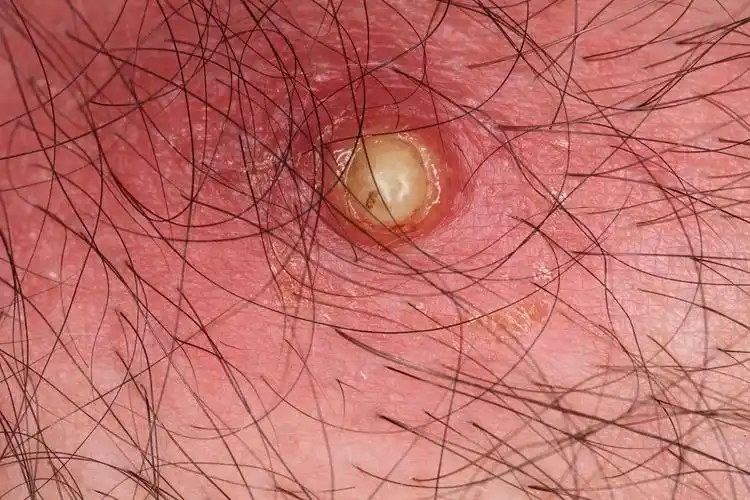 奇怪病皮肤出现小眼结痂一挤挤出虫子