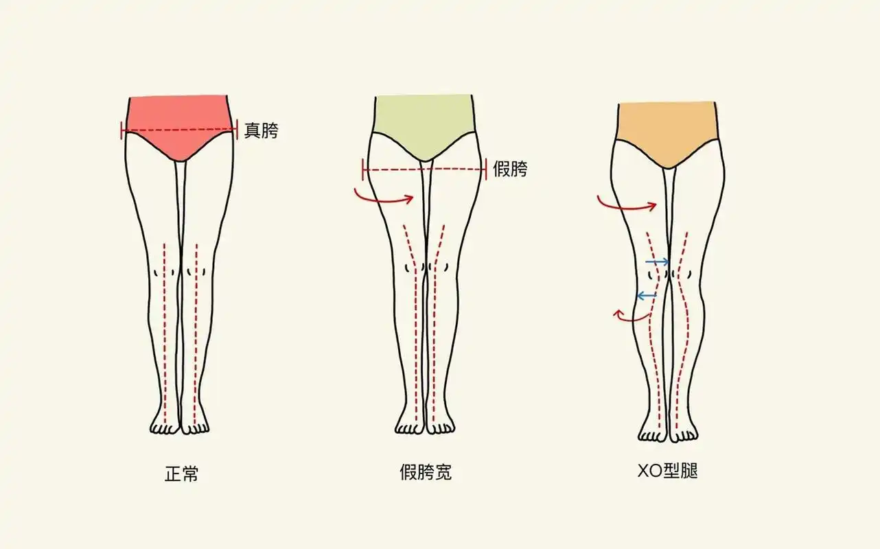 (图1)假胯宽就是大转子的位置比较宽,相比真胯宽的人视觉上显得