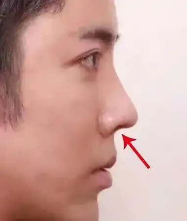鼻小柱内凹是什么如何改善