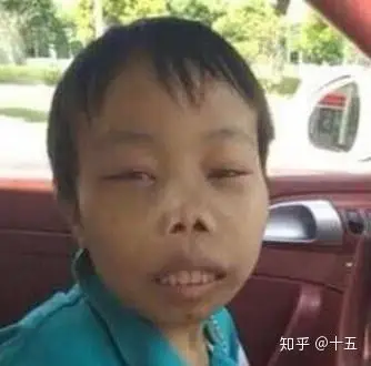 关于地中海贫血,你想知道的都在这里了