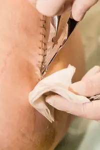 顺产撕裂伤口图片