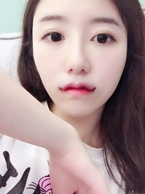 m唇综合一招解决】现代社会_圈子-新氧美容整形